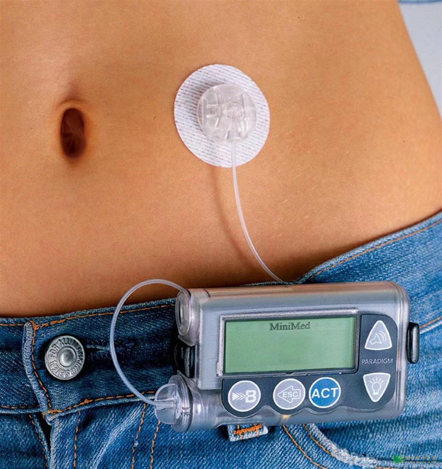 美敦力 （Medtronic）进口家用胰岛素泵MMT-722WWS（英文版）-3